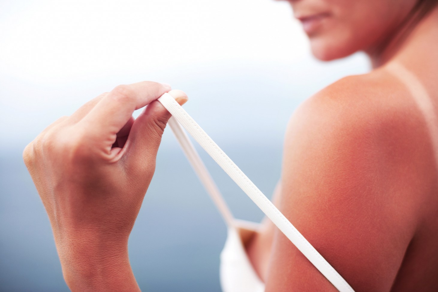 A napégésért a hosszúhullámú UV-B sugarak a felelősek